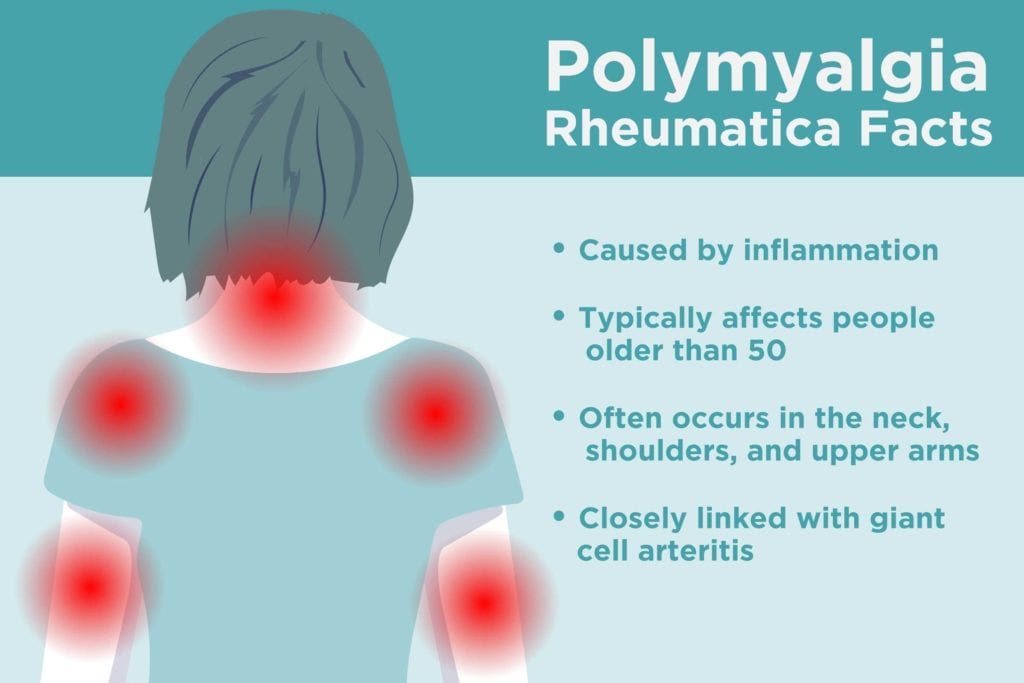 Polymyalgia rheumatica facts