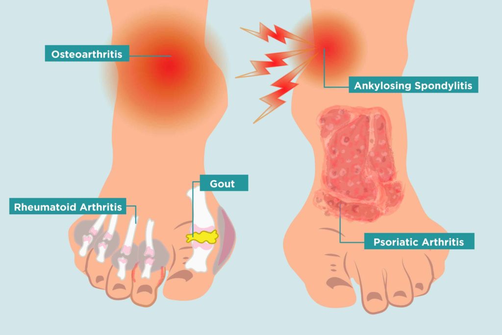 Realign your toes, relieve foot pain and restore healthy foot function