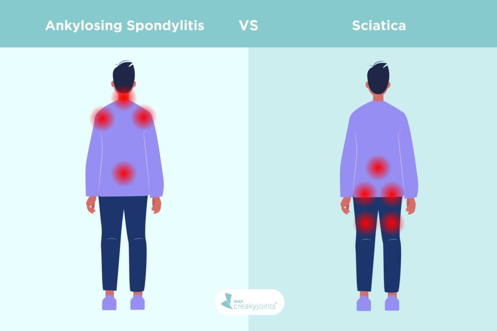 Ankylosing spondylitis versus sciatica