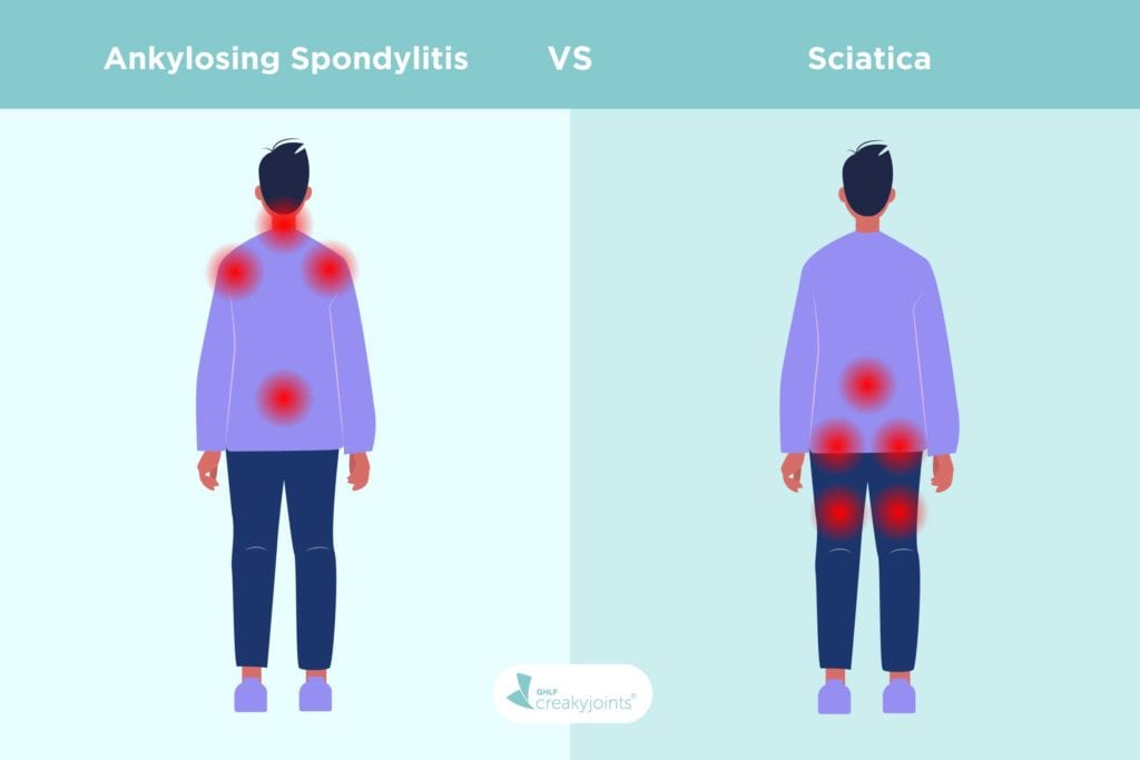 Sciatica: Of all the nerve - Harvard Health