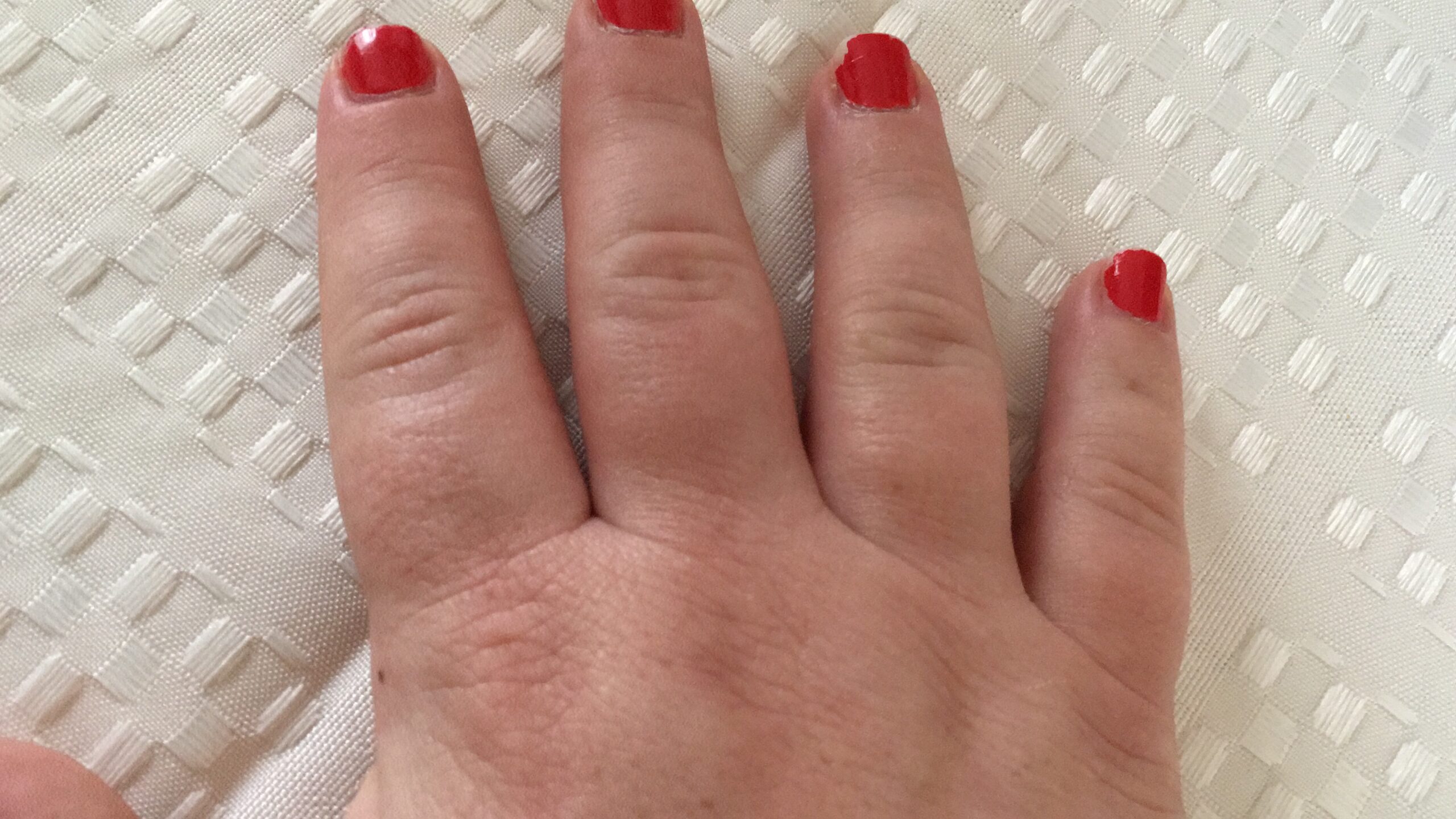 Swollen fingers